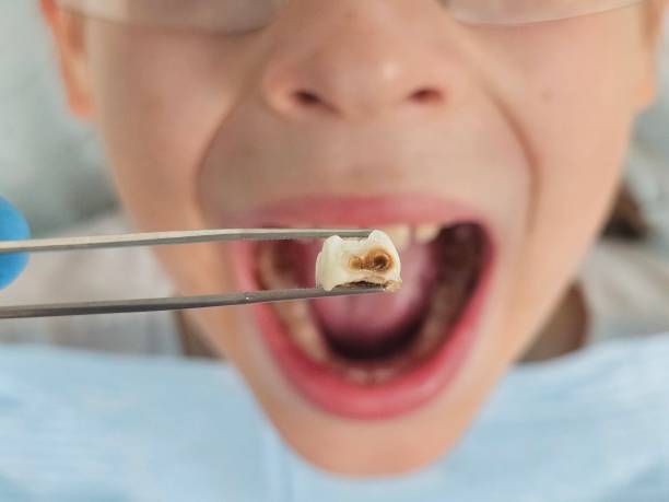 Best Urgent Care for Lost Fillings or Crowns in Marquette Heights, IL